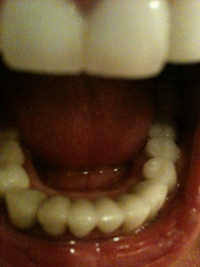 bulimia damaged teeth being replaced