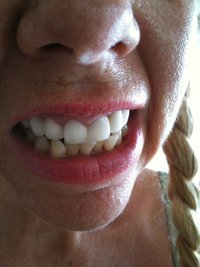 bulimia botton teeth like cheese before treatment