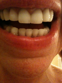 bulimia teeth after