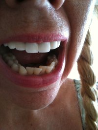 Bulimia nervosa effects rots teeth they are as soft as cheese after years of bulimia