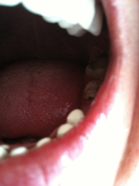Treatment for bulimia rotting teeth