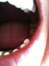 Treatment for bulimia rotting teeth