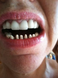 during treatment for bulimia rotted teeth replacement